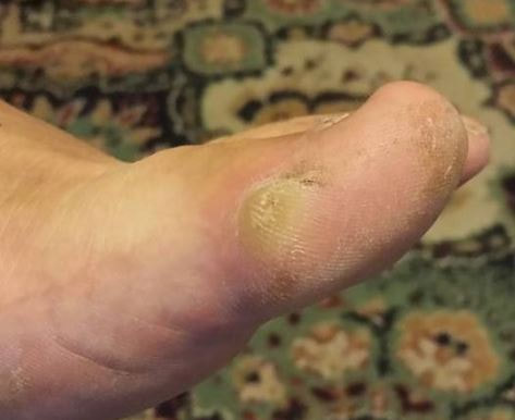 How to Get Rid of Calluses - 7 Tips to Remove a Callus Safely
