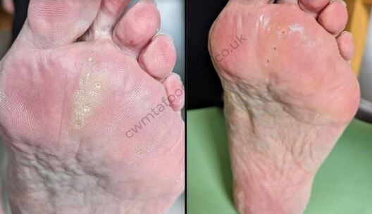 Foot Corn Removal by Cosmetic Podiatrist - Moore Foot and Ankle Specialists