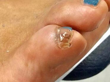Do You Have An Accessory Toenail That Keeps Coming Back? | Split Pinky  Toenail