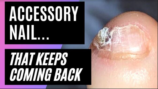 Do You Have An Accessory Toenail That Keeps Coming Back? | Split Pinky  Toenail