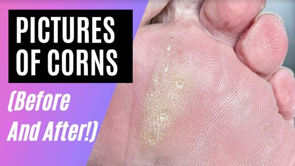 Satisfying hard skin on foot callus removal 