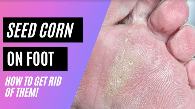 Why You Should Never DIY Corn And Callus Removal