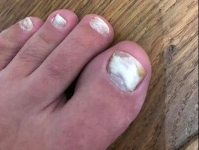 White Spots On Toenails After Removing Polish? | Shellac Nail Damage